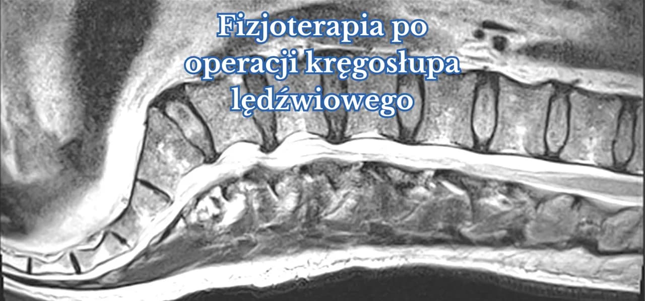 Kiedy rehabilitacja po operacji kręgosłupa lędźwiowego? Kluczowe informacje